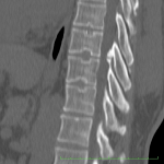 calcification du ligament longitudinal antérieur