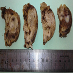 Rhabdoid tumor of the thyroid gland: a variant of anaplastic carcinoma ...