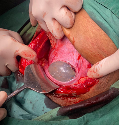 Intact amniotic sac prolapsing through a lower uterine segment rupture: a striking intraoperative image