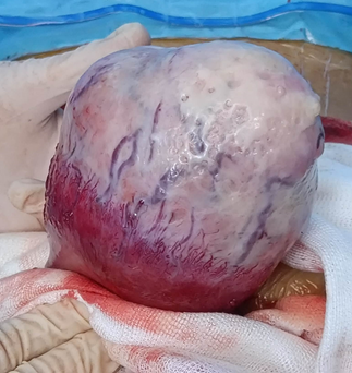 Postoperative discovery of a uterine sarcoma