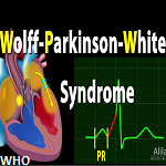 Wolf-Parkinson-White syndrome