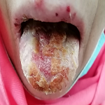 uremic stomatitis